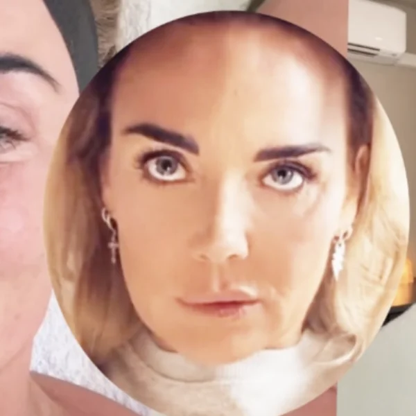 Monique Westenberg liegt staalhard over kromme lippen: &acute;Zitten wel degelijk fillers in!&acute;