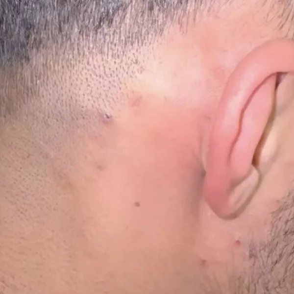 Kapper komt 3 jaar oude ingegroeide haar tegen en besluit hem eruit te pulken