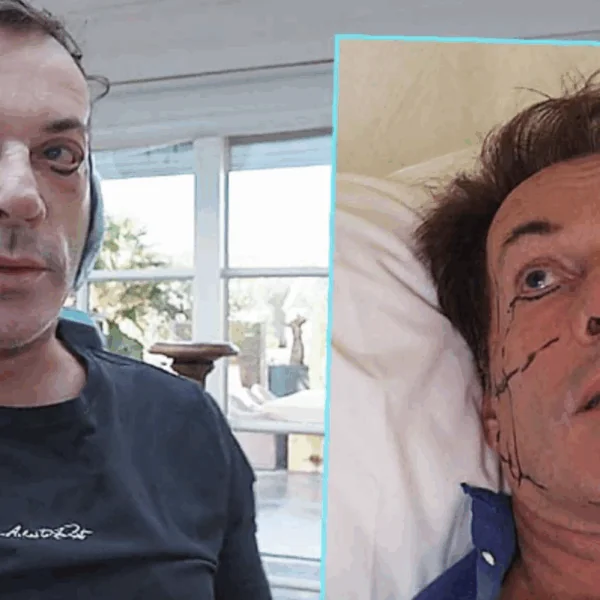 Gerard Joling compleet doorgeslagen met heftige cosmetische ingreep: &acute;Wat een schrikbeeld!&acute;