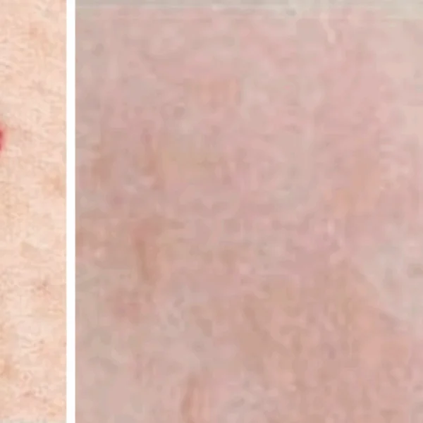 Let op: Als je deze rode stippen op je huid ziet, is het belangrijk om te weten wat ze betekenen