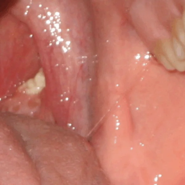 Dit moet je echt weten over de vreemde puistachtige gezwellen in je keel