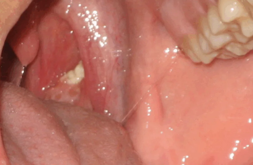 Dit moet je echt weten over de vreemde puistachtige gezwellen in je keel