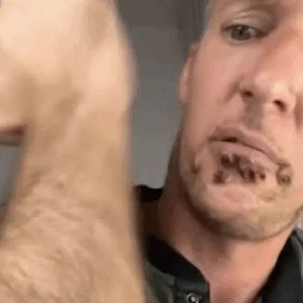 Breaking: Nieuwe variant apenpokken uitgebroken in Nederland