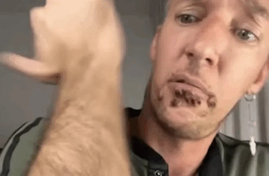 Breaking: Nieuwe variant apenpokken uitgebroken in Nederland