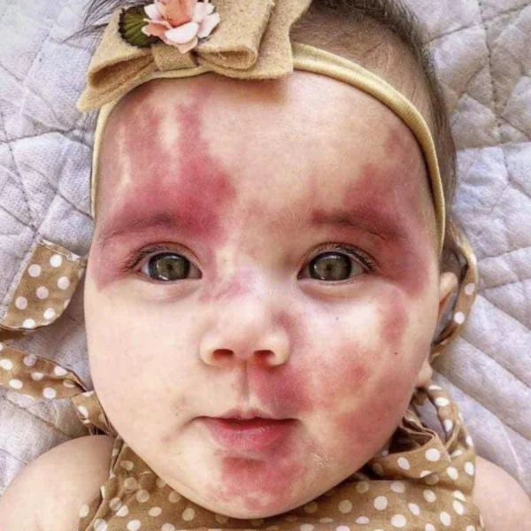 &lsquo;Haar gezicht zag er gegrild uit&rsquo;: baby werd &lsquo;afschuwelijk&rsquo; en &lsquo;defect&rsquo; genoemd toen ze werd geboren, maar wacht tot je deze kleine prinses vandaag ziet